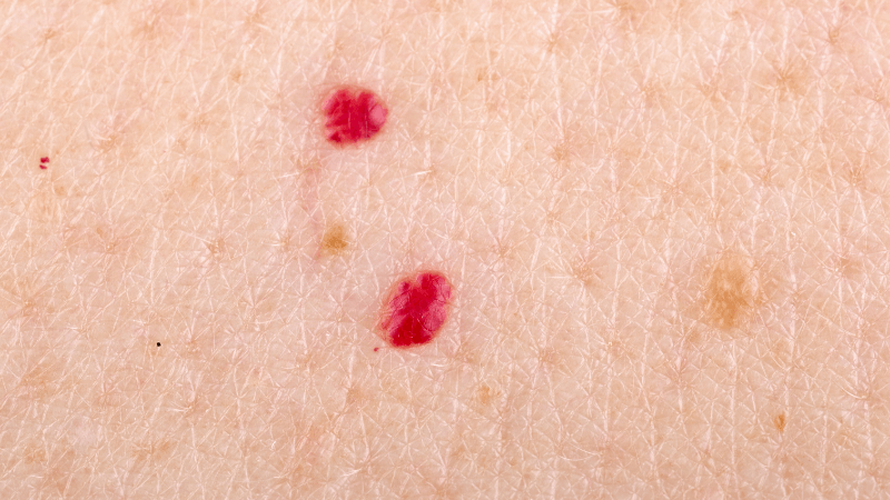 angioma