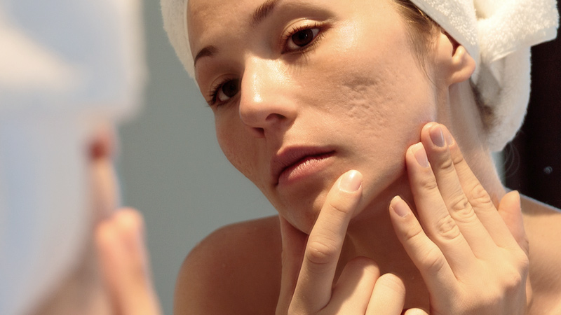 cicatrici acne