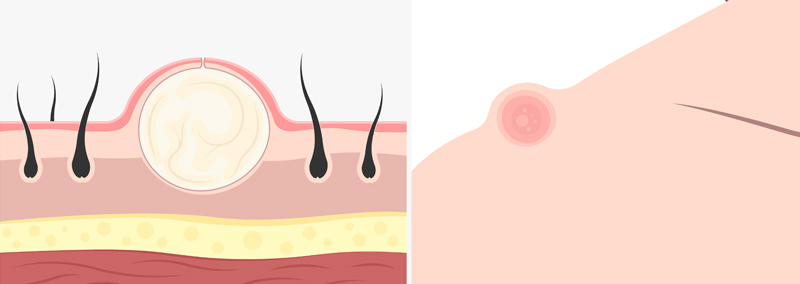 cisti sebacee