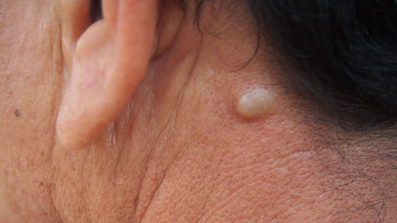 angioma
