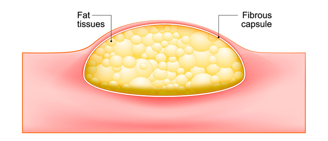 lipoma
