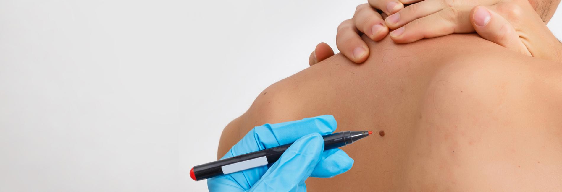 Procedure chirurgiche o mininvasive eseguite sulla pelle <br />per trattare varie condizioni come angiomi, cheratosi, nevi, <br />verruche e rimozioni di altre lesioni cutanee. CHIRURGIA DERMATOLOGICA