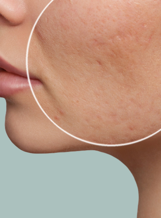 &nbsp Rimozione di Cicatrici acneiche<br />tramite Terapia Laser  <span style="color:#5b6571;">LASERTERAPIA</span> <br />CICATRICI ACNE