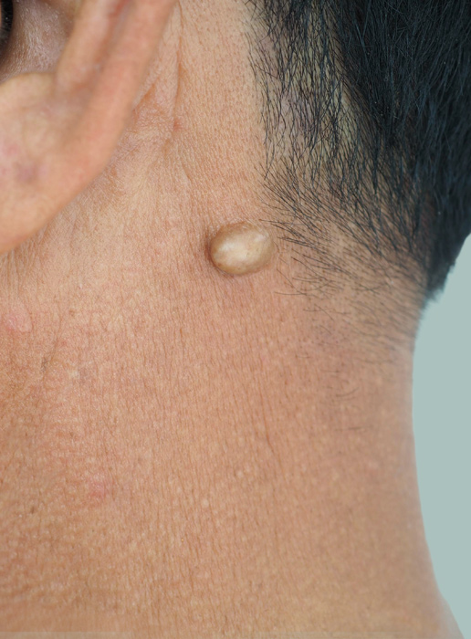&nbsp Asportazione Cisti sebacee <BR />senza cicatrici tramite Laser  <span style="color:#5b6571;">RIMOZIONE</span> <br />CISTI SEBACEE