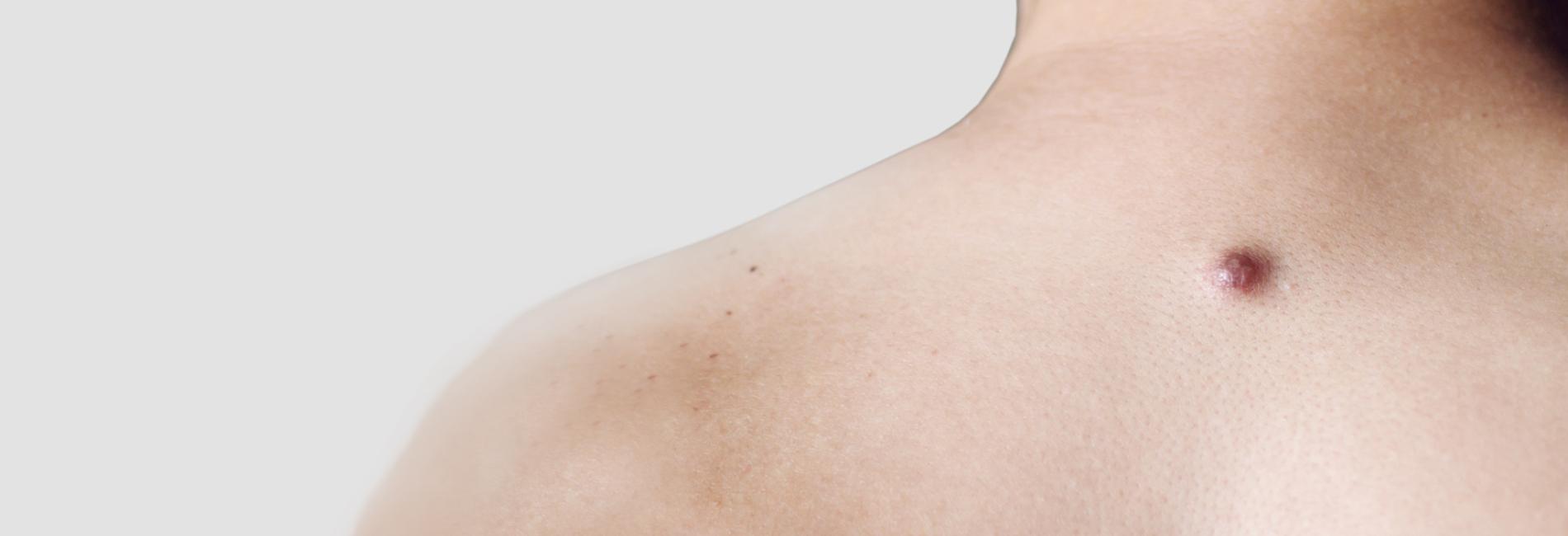 Eliminare i Dermatofibromi con il Laser Frazionato <span style="color:#5b6571;">RIMOZIONE</span> <br />DERMATOFIBROMI