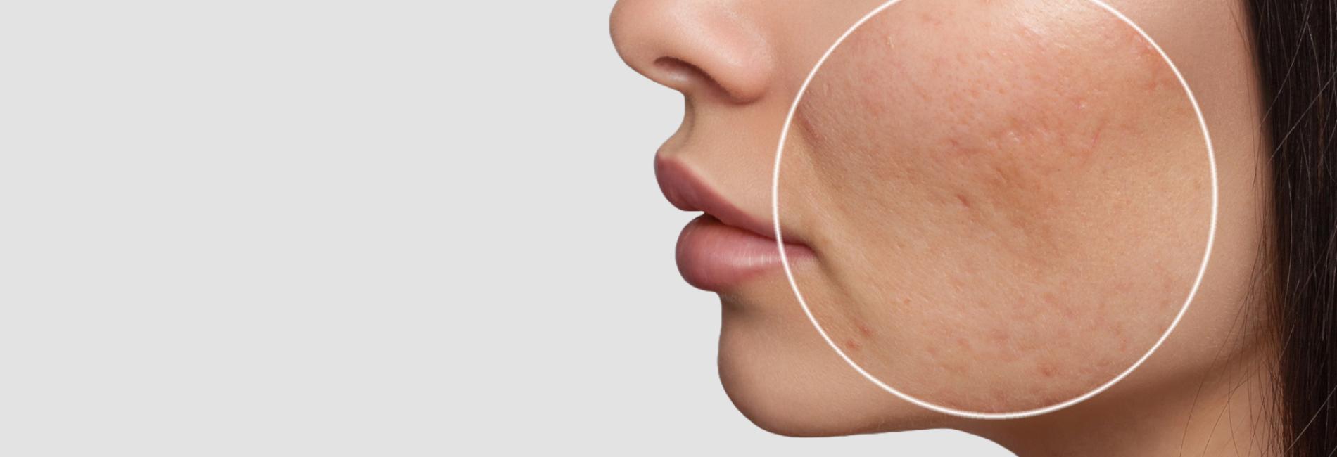 Rimozione di Cicatrici acneiche tramite Terapia Laser <span style="color:#5b6571;">LASERTERAPIA</span> CICATRICI ACNE
