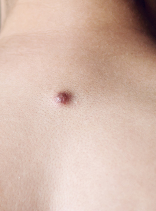 &nbsp Eliminare i Dermatofibromi con il Laser Frazionato  <span style="color:#5b6571;">RIMOZIONE</span> <br />DERMATOFIBROMI
