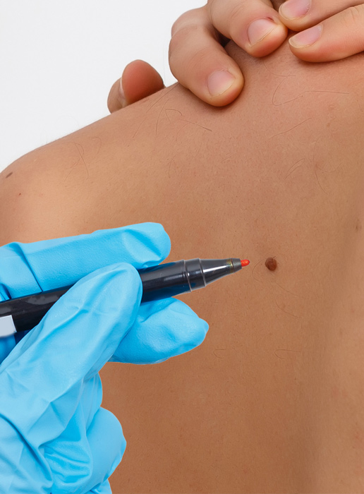 &nbsp Procedure chirurgiche per trattare varie condizioni come angiomi, cheratosi, nevi, verruche e rimozioni<BR /> di altre lesioni cutanee.  <span style="color:#5b6571;">CHIRURGIA</span><br />DERMATOLOGICA